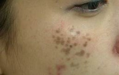 Nám chân sâu và những điều bạn nên biết 